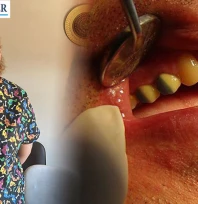 Kaplama diş neden düşer?