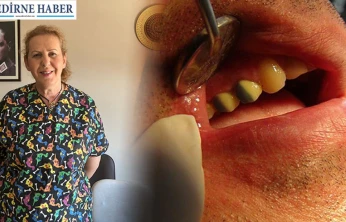 Kaplama diş neden düşer?