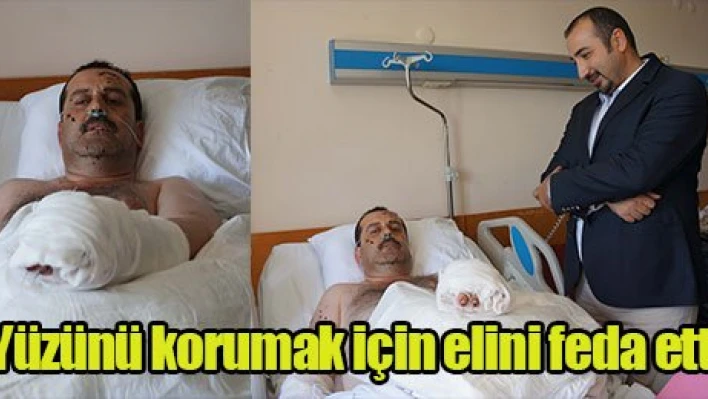 Yüzünü korumak için elini feda etti