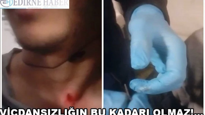 Sığınmacının boynuna saplanan plastik mermi çıkarıldı