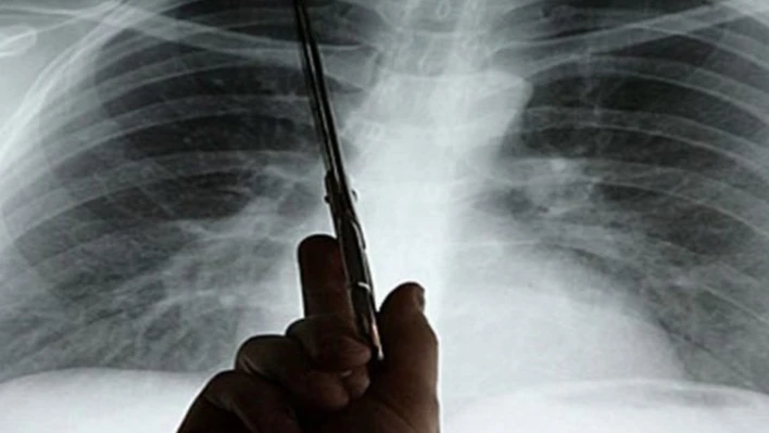 Kadın kanserlerinin 8 belirtisine dikkat!