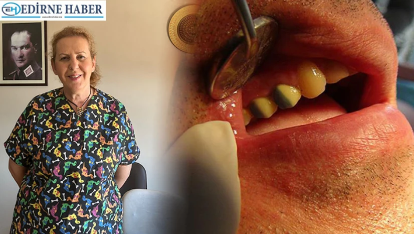 Kaplama diş neden düşer?